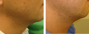 Guna Biolifting-Bioshaping