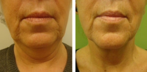 Guna Biolifting-Bioshaping