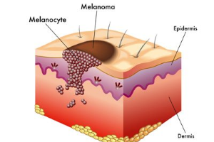 Bőrgyógyászat -anyajegyvizsgálat - melanomaszűrés