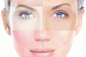Bőrgyógyászat - Rosacea kezelése