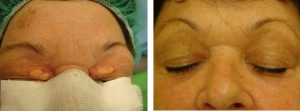 Xanthelasma - szemhéj körüli zsírcsomó lézeres eltávolítása